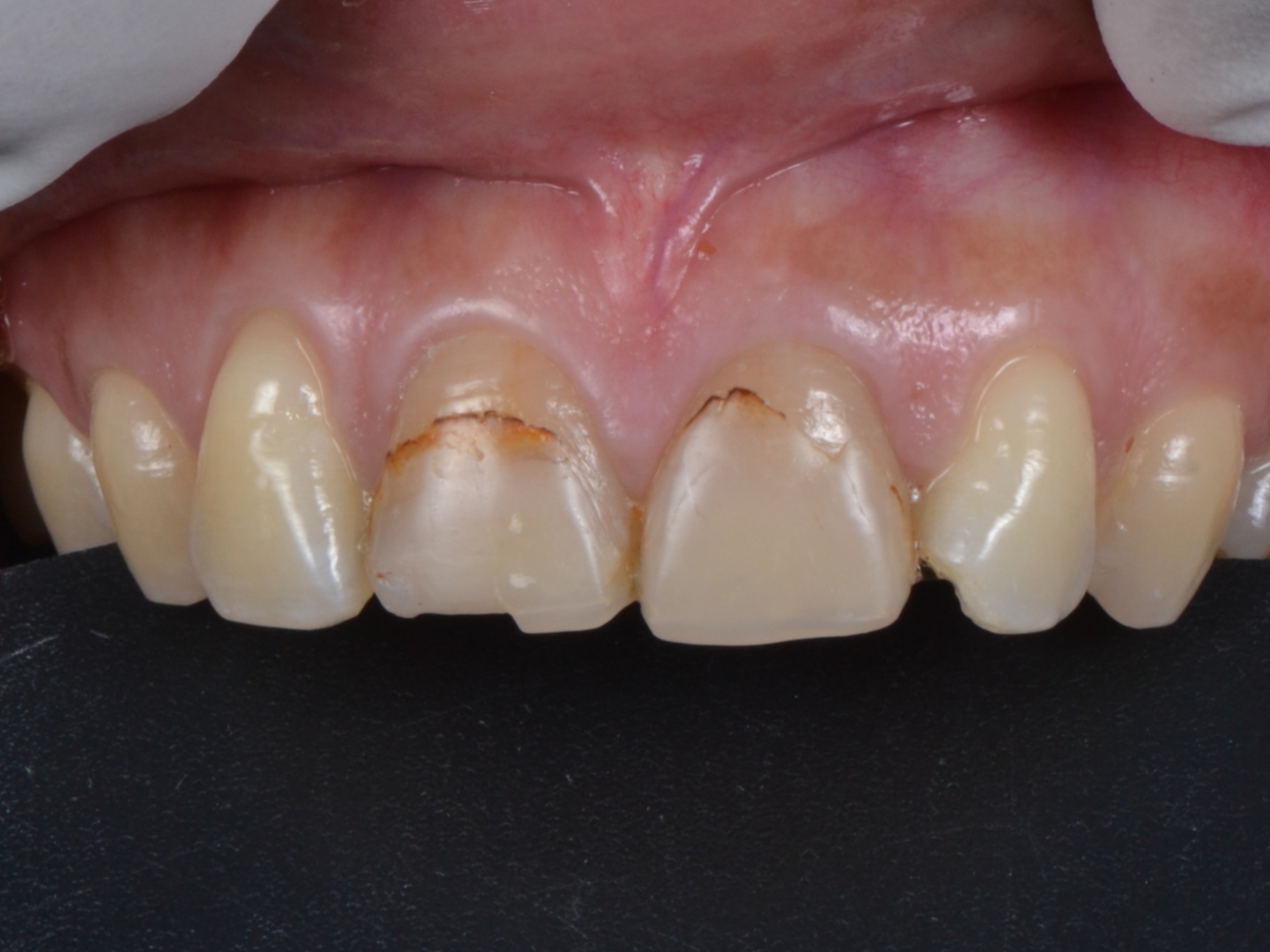 Sebelum-composite-veneer-case-31.jpg