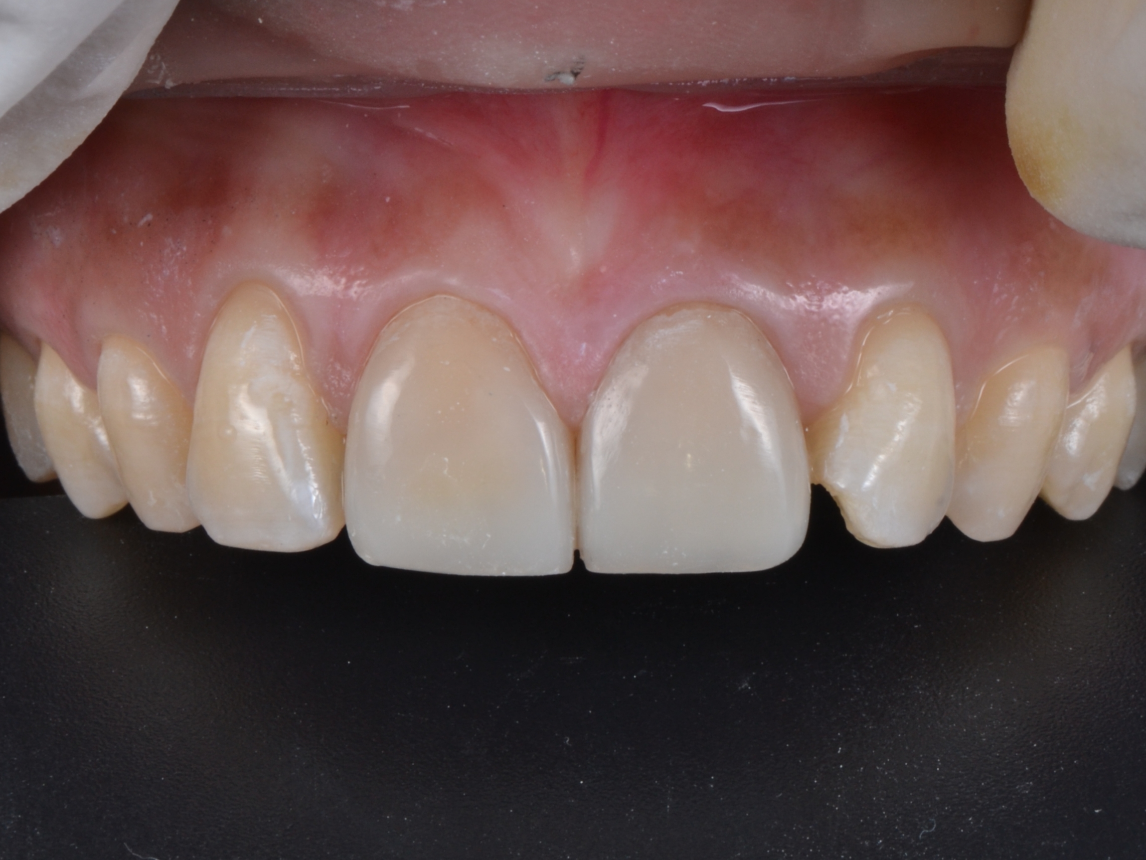 sebelum-composite-veneer-case-3.jpg