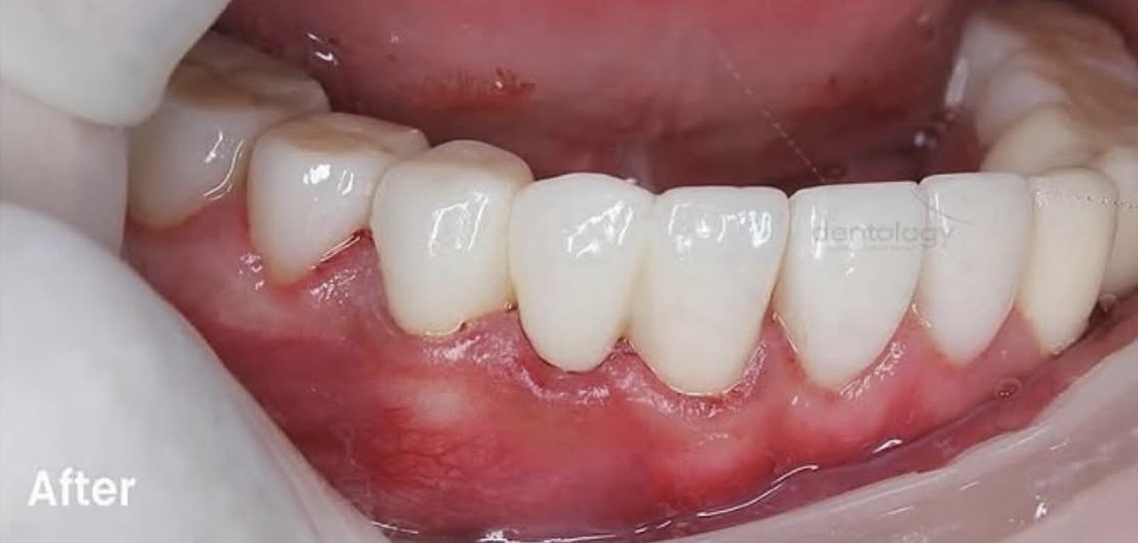 Prosthodontic- dokter gigi denpasar