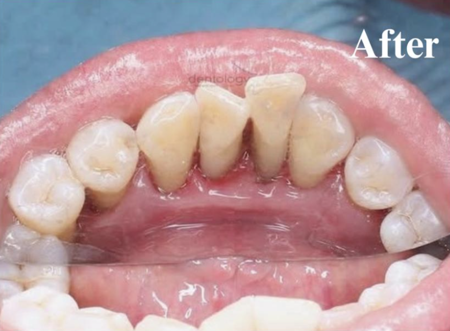 Periodontic dokter gigi denpasar